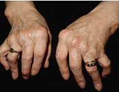 two hands with advanced arthritis